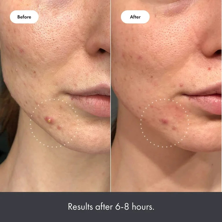 Hydrocolloid Acne Pimple Patch